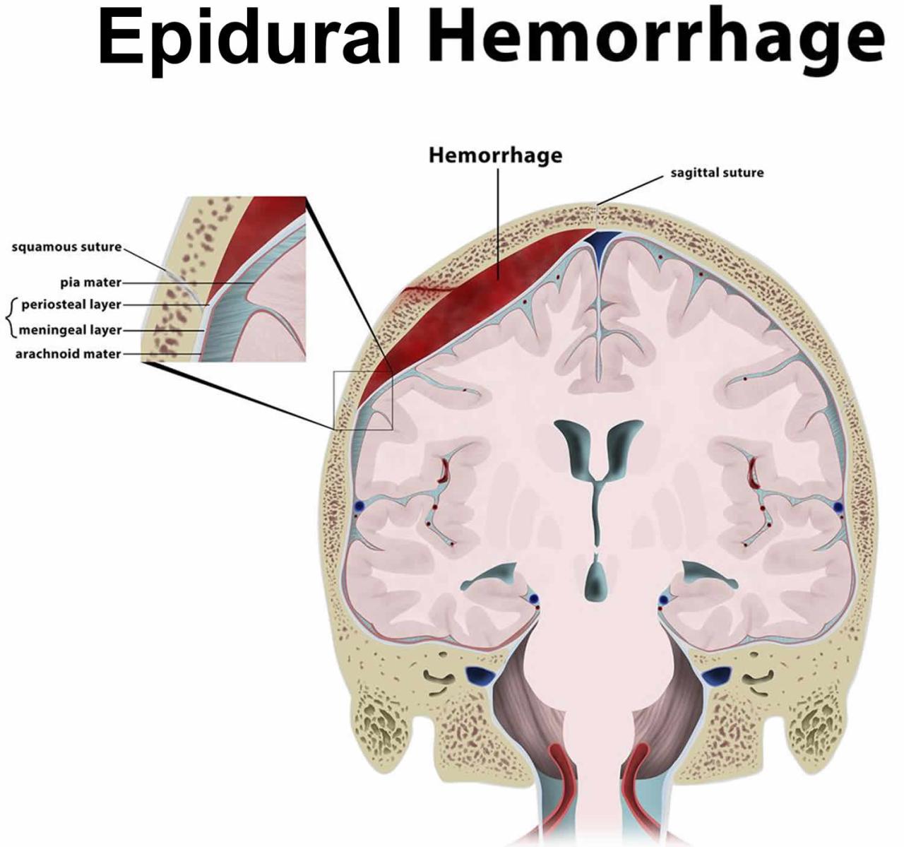 Does health insurance cover subgaleal hematoma treatment