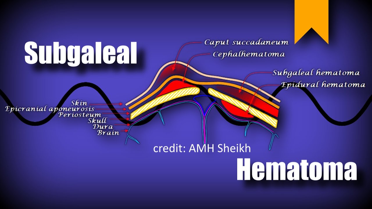 Does health insurance cover subgaleal hematoma treatment